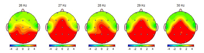 AEEG showing signs of PTSD
