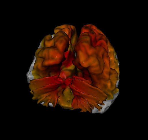 typical loreta neurofeedback results on a brain with PTSD